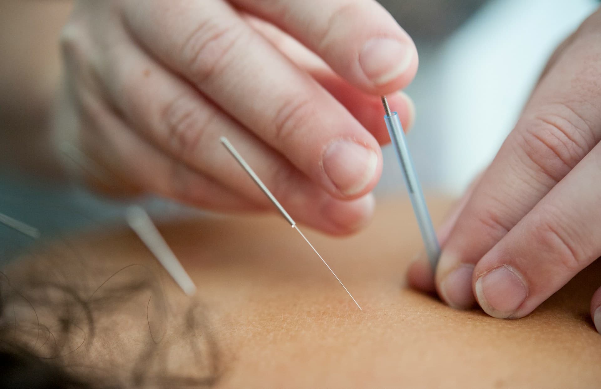 acupuncture for seniors